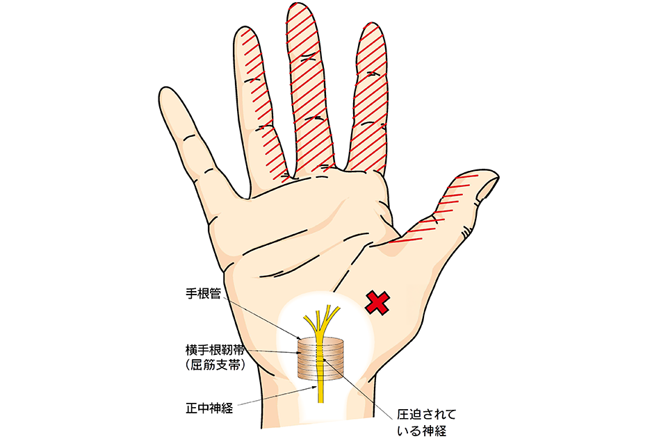 Carpal_tunnel_syndrome