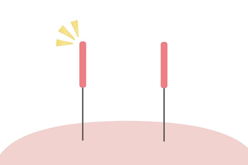 acupuncture